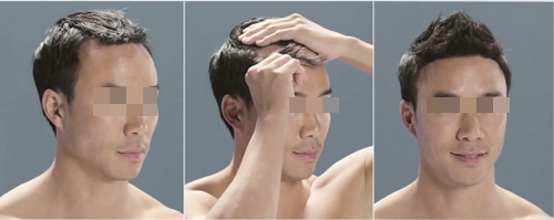 이지헤어라인 이미지