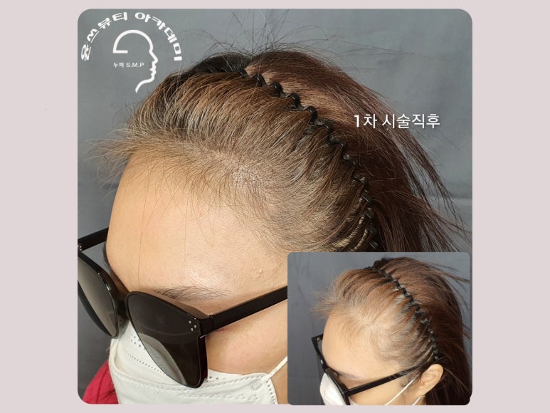 은혜헤어라인 이미지