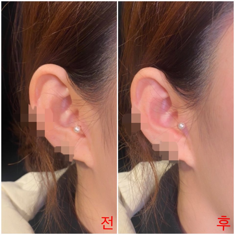 우엉재피어싱 이미지