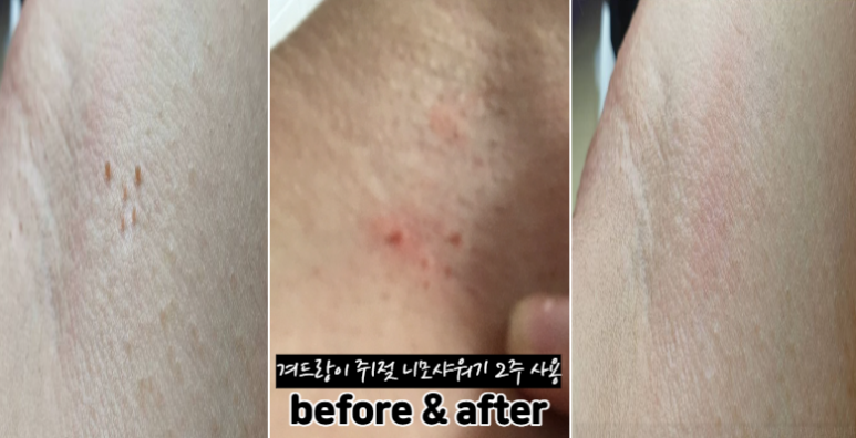 겨드랑이 쥐젖 제거 전염 안되려면? : 네이버 블로그