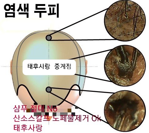두피탈모태후사랑 이미지