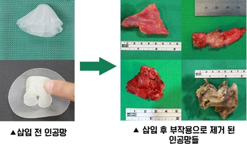 인지망 이미지