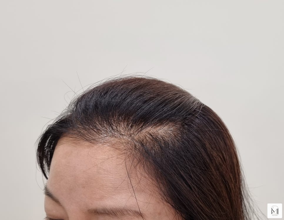미로헤어라인 이미지
