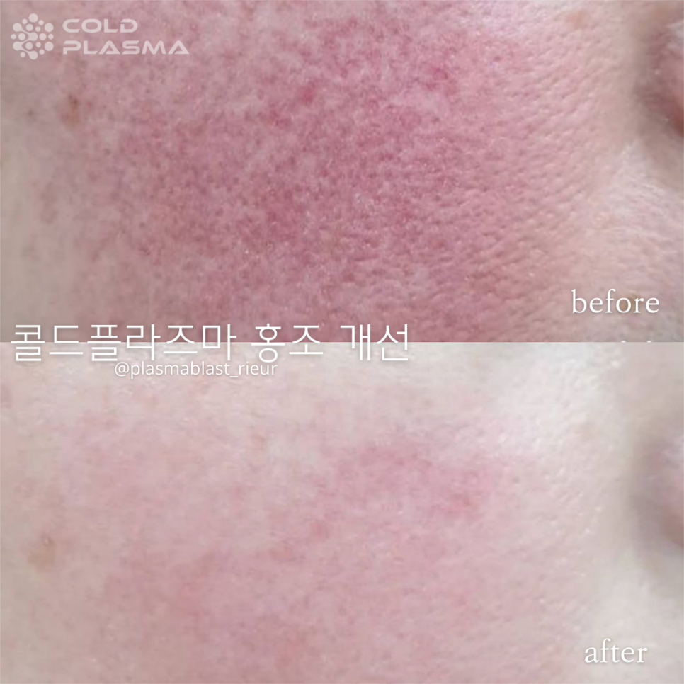 콜드플라즈마 이미지