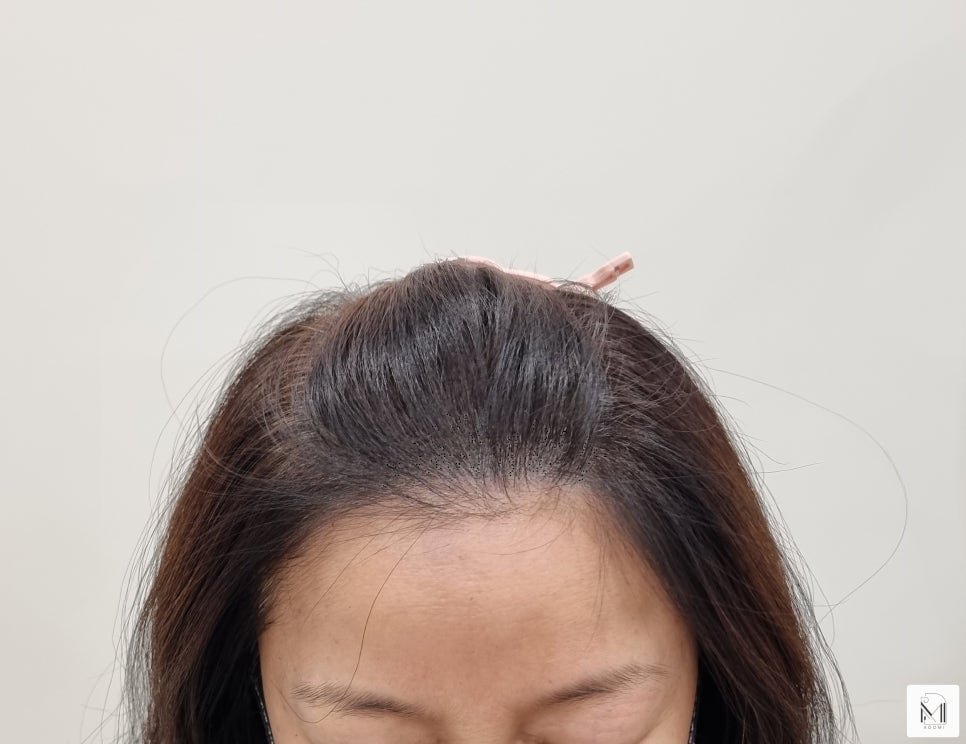 미로헤어라인 이미지