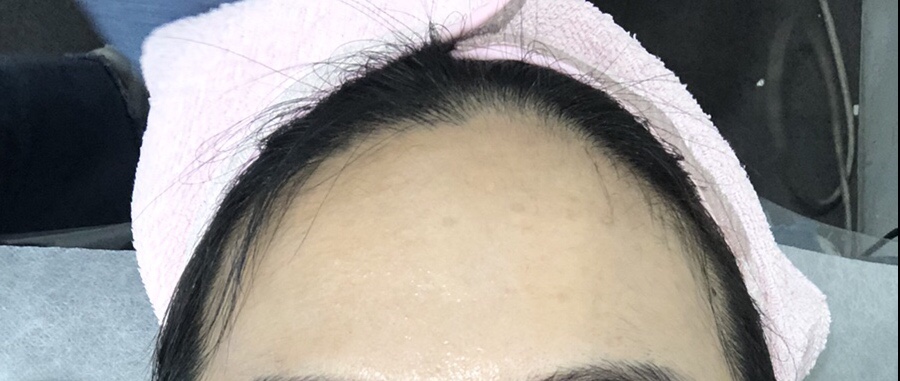 미가헤어라인 이미지