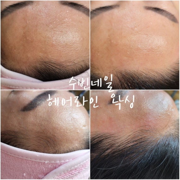 수빈헤어라인 이미지