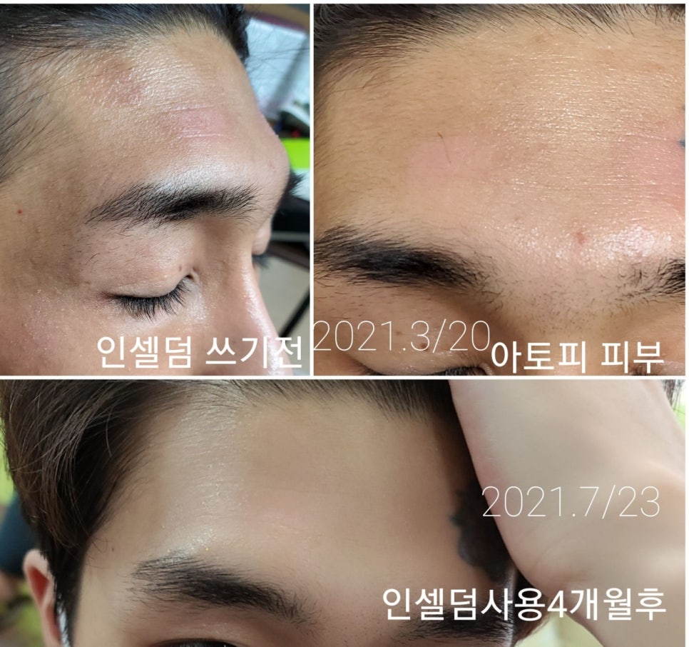인셀덤237대리점 이미지