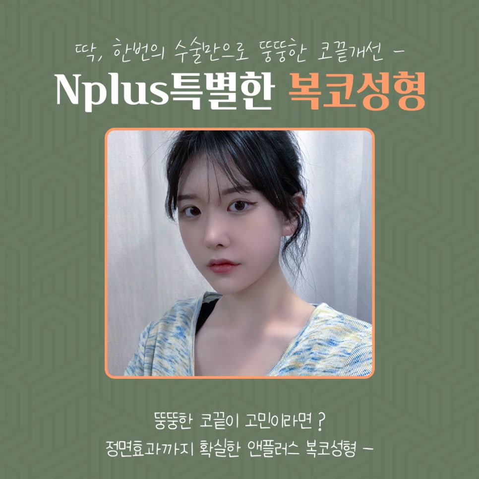 Rhinoplasty Review for a Bulbous Nose Through Nose Fat Removal image 2