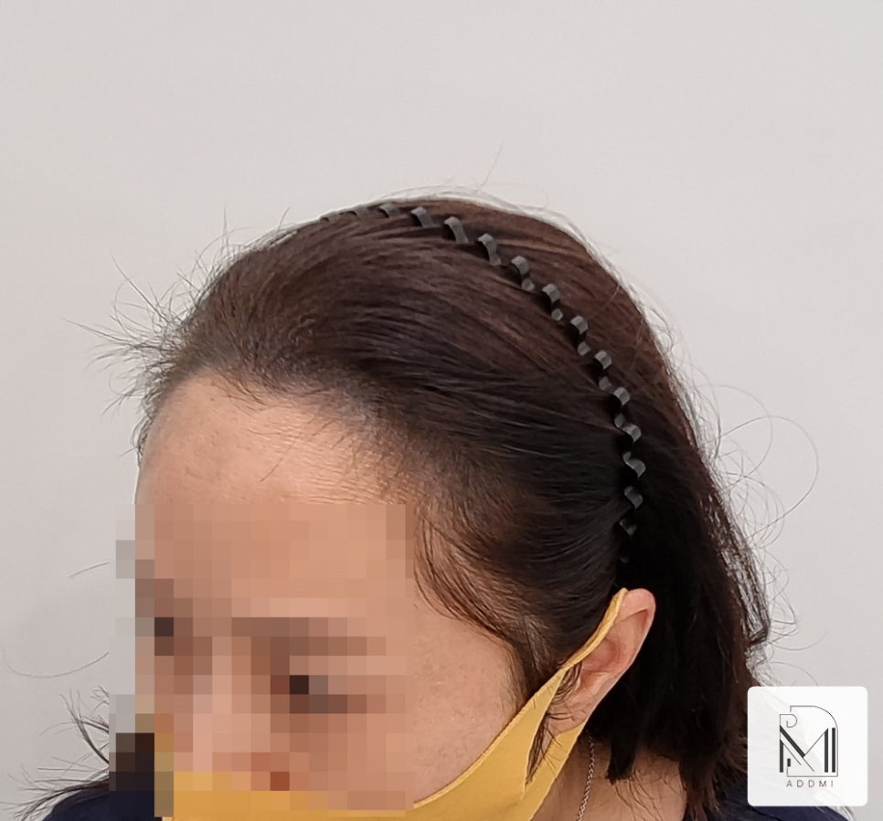 미로헤어라인 이미지