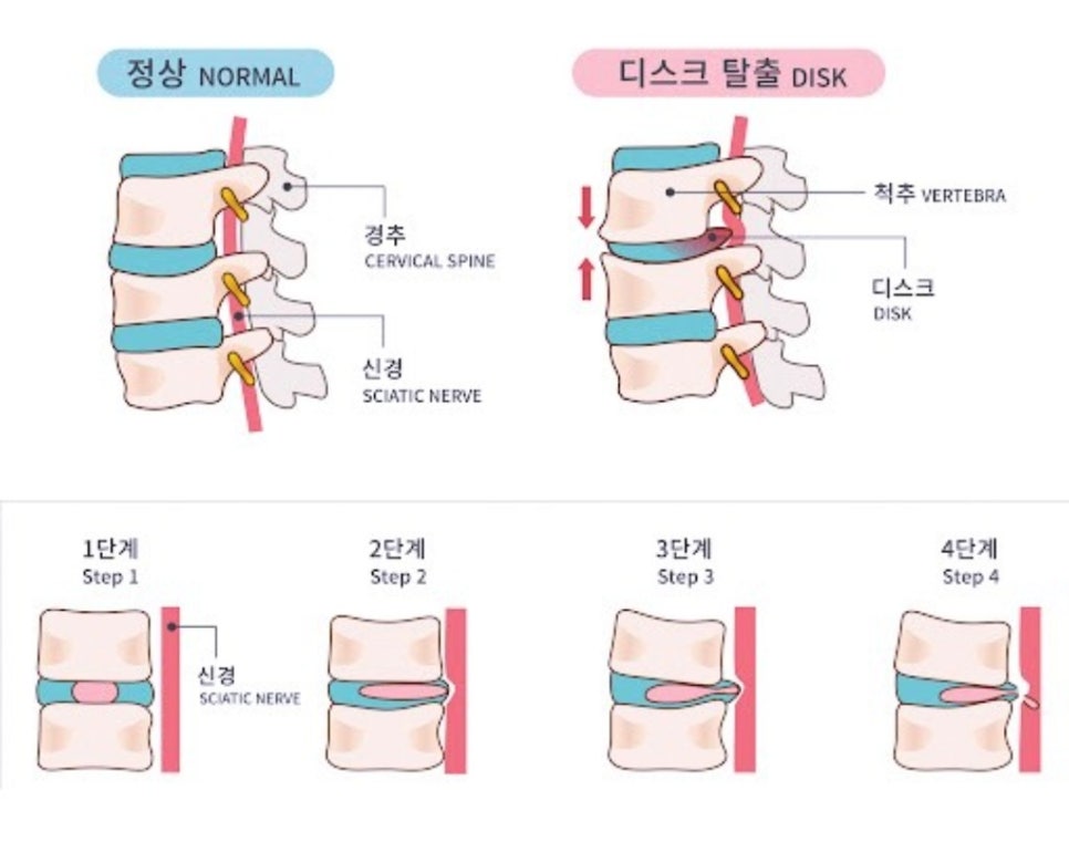 턴핏 이미지