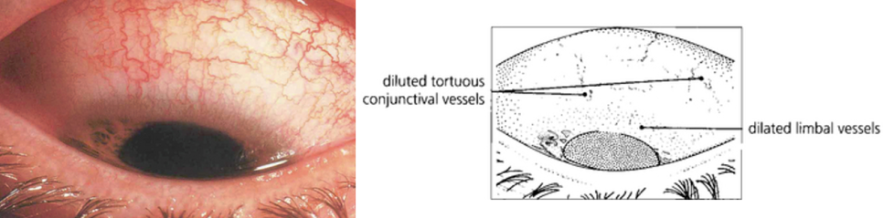 [EYE잘보여] '결막(Conjunctiva)'을 소개합니다. : 네이버 블로그