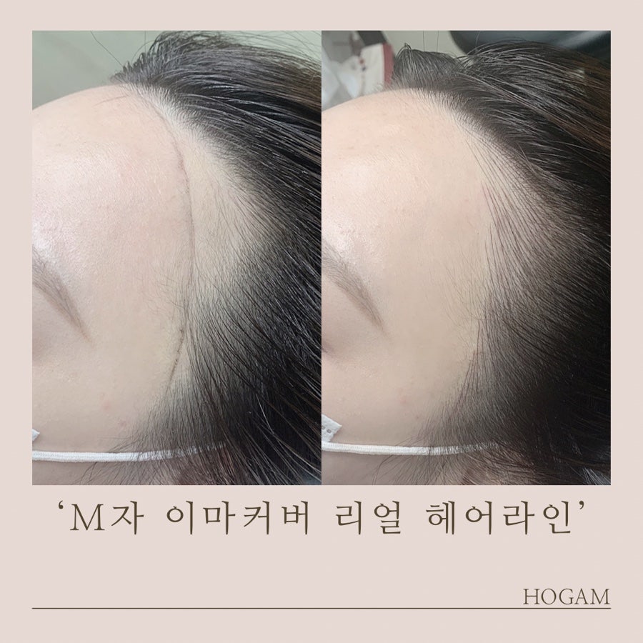 체인지헤어라인 이미지