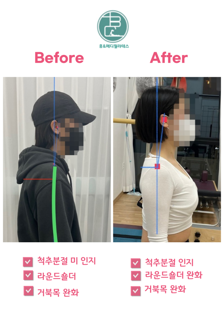 휴자세교정 이미지
