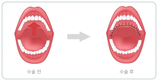 법인두그린 이미지