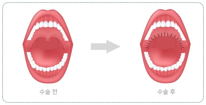 법인두그린 이미지
