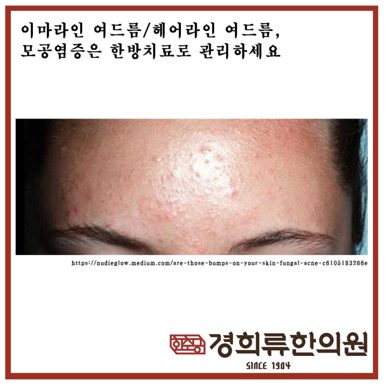 류헤어라인 이미지