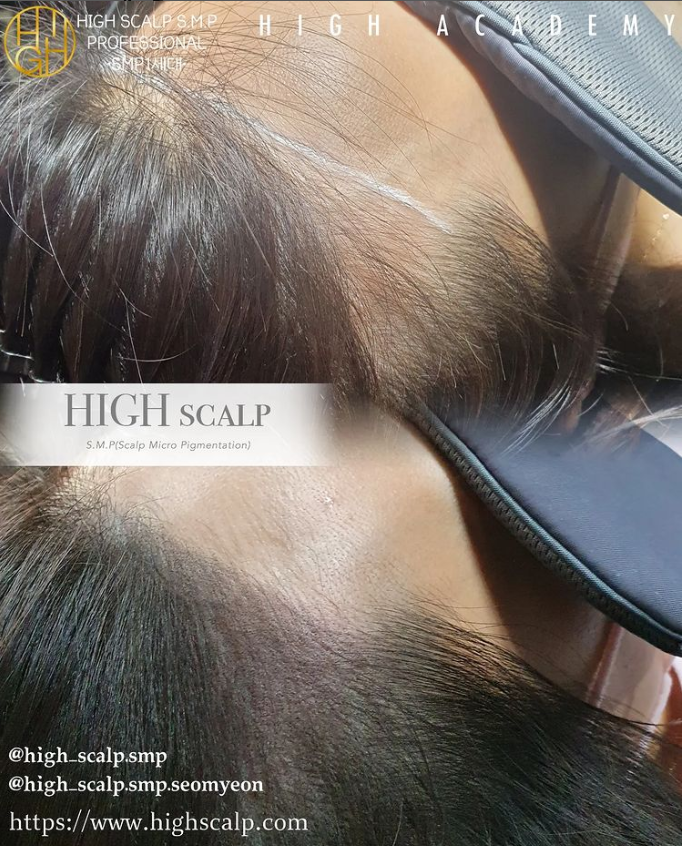 하이스칼프 이미지