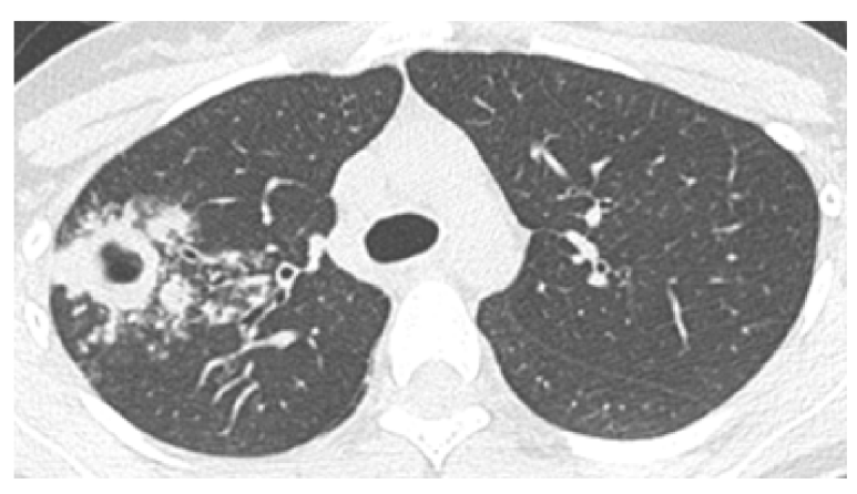 활동성 폐결핵 엑스레이 증례, 공동성 결절, 결핵 x-ray 소견 : 네이버 블로그