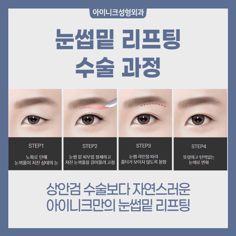 중년눈성형 고민이라면? 관련 이미지 4