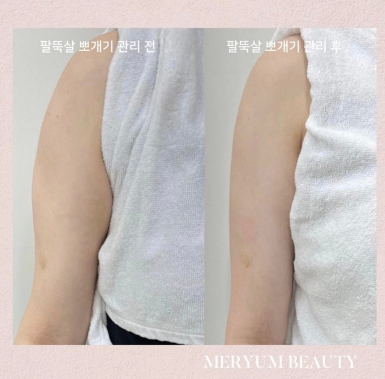 썬체형관리 이미지