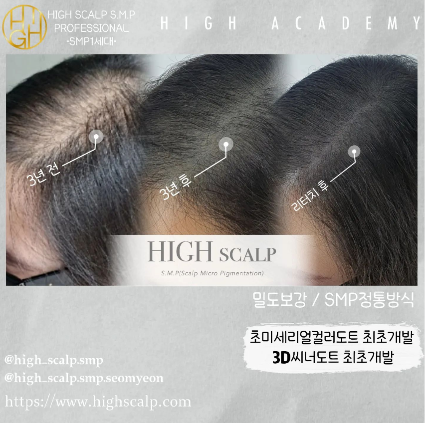 하이스칼프 이미지