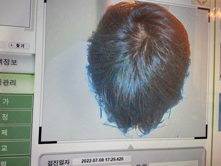 이안두피탈모 이미지