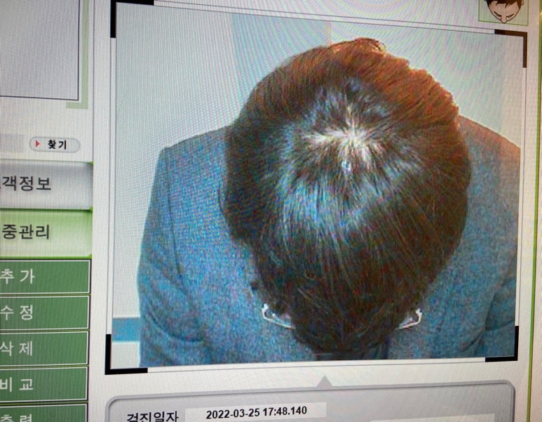 이안두피탈모 이미지