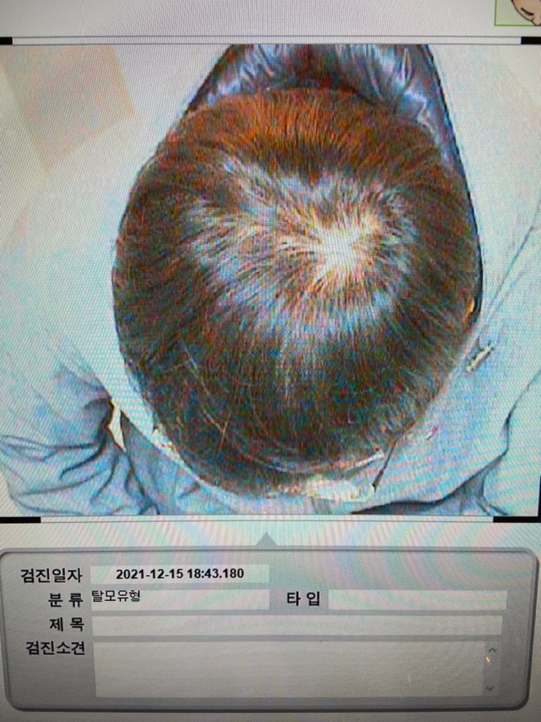 이안두피탈모 이미지