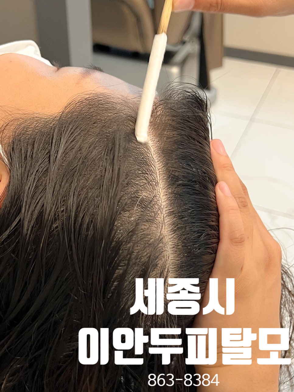이안두피탈모 이미지