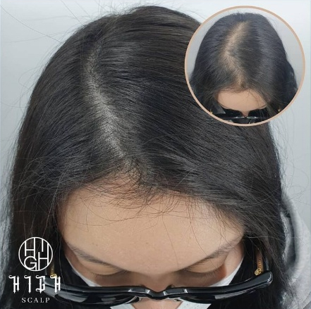 하이스칼프 이미지