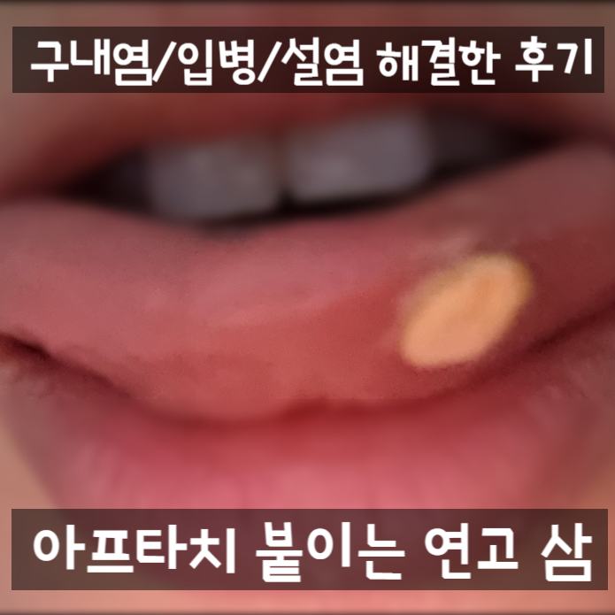 입병 구내염 붙히는 약으로 치료하기(사진있음/혐오주의) 아프타치 : 네이버 블로그