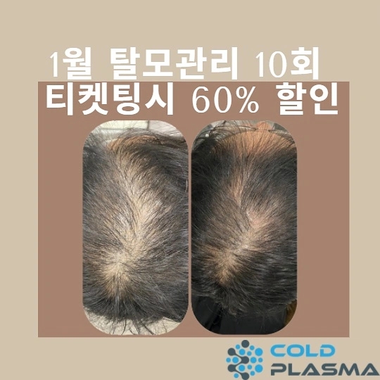 콜드플라즈마 이미지