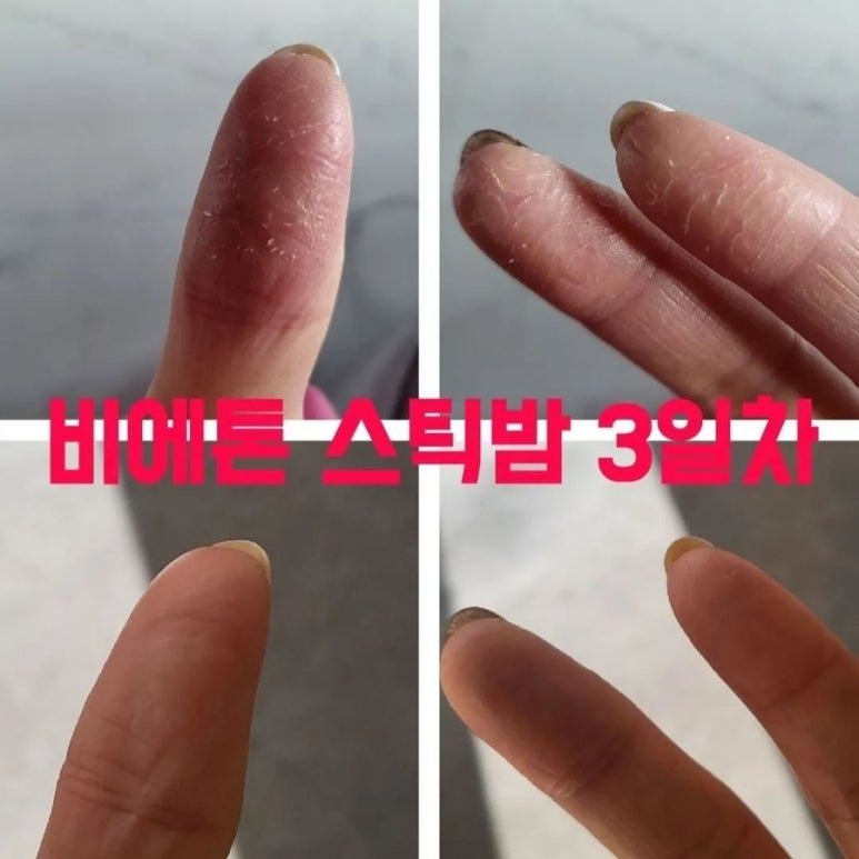 인셀덤 대구 이미지