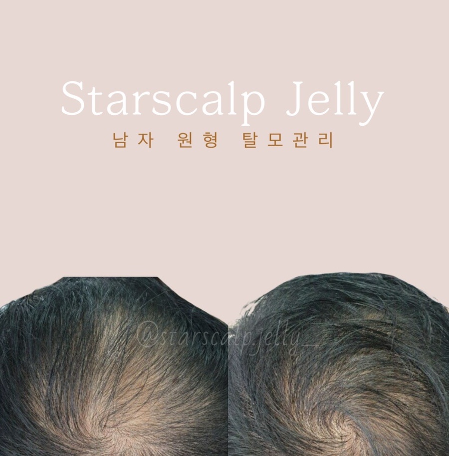 지니스칼프 이미지