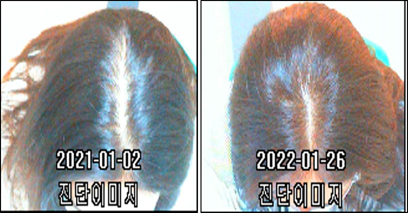 이안두피탈모 이미지