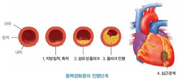 경화반점 이미지