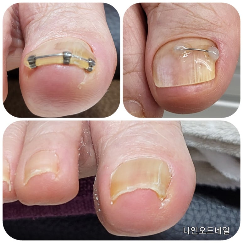 오드네일 이미지
