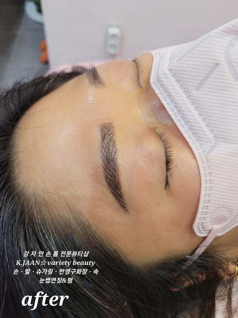 강자안손톱 이미지