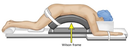 [NS수술] PHL(Partial Hemilaminectomy, 부분 후궁 절제술) : 네이버 블로그