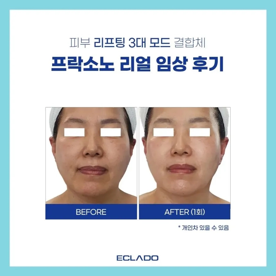소노뷰티 이미지