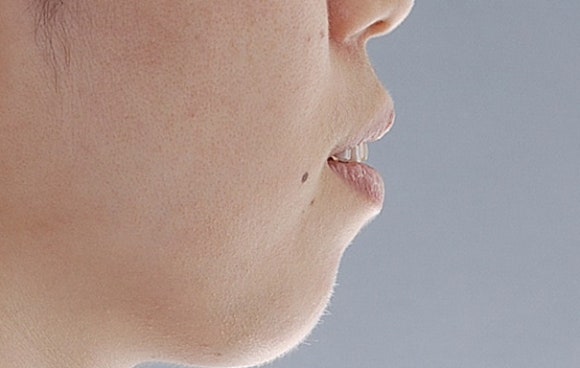 돌출입 치료 전 사진