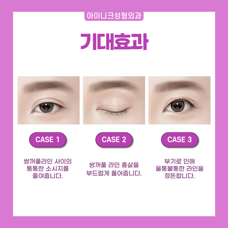Directly Developed Sausage-Eye Injection for Easy Improvement of Swelling After Double Eyelid Surgery image 3