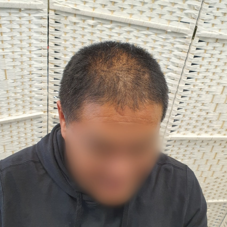 김호증모가발by헤어리서치 이미지