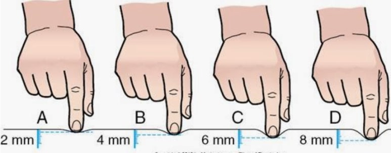 [기초지식] 부종의 의미와 단계(Edema) : 네이버 블로그