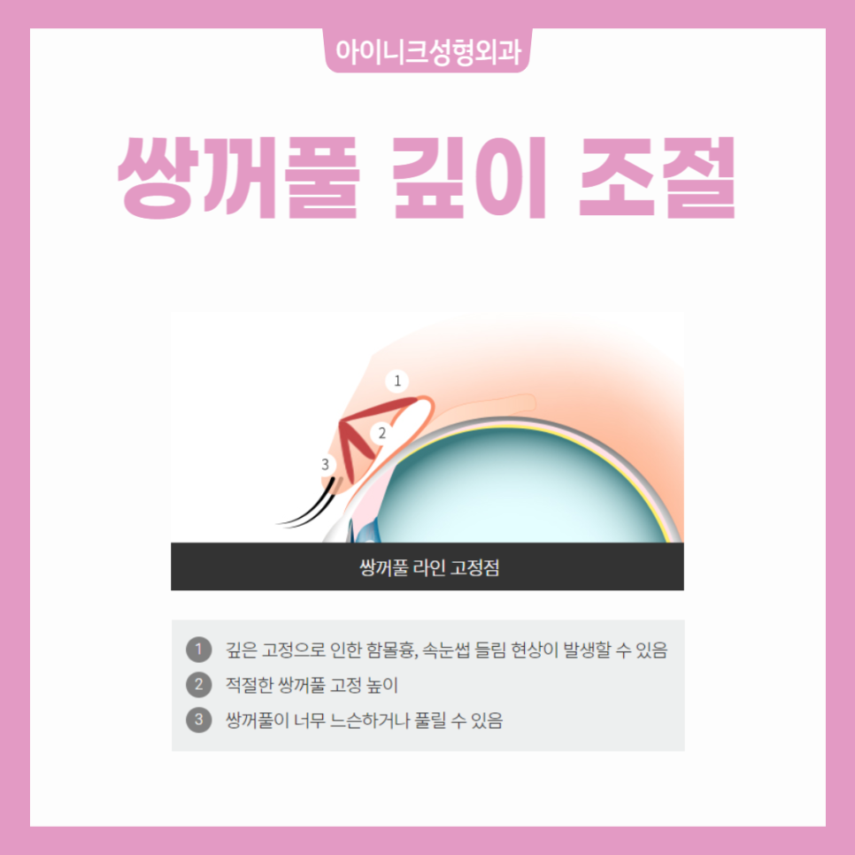 쌍수흉터, 쌍꺼풀 함몰흉 왜 생기는 걸까? 관련 이미지 3