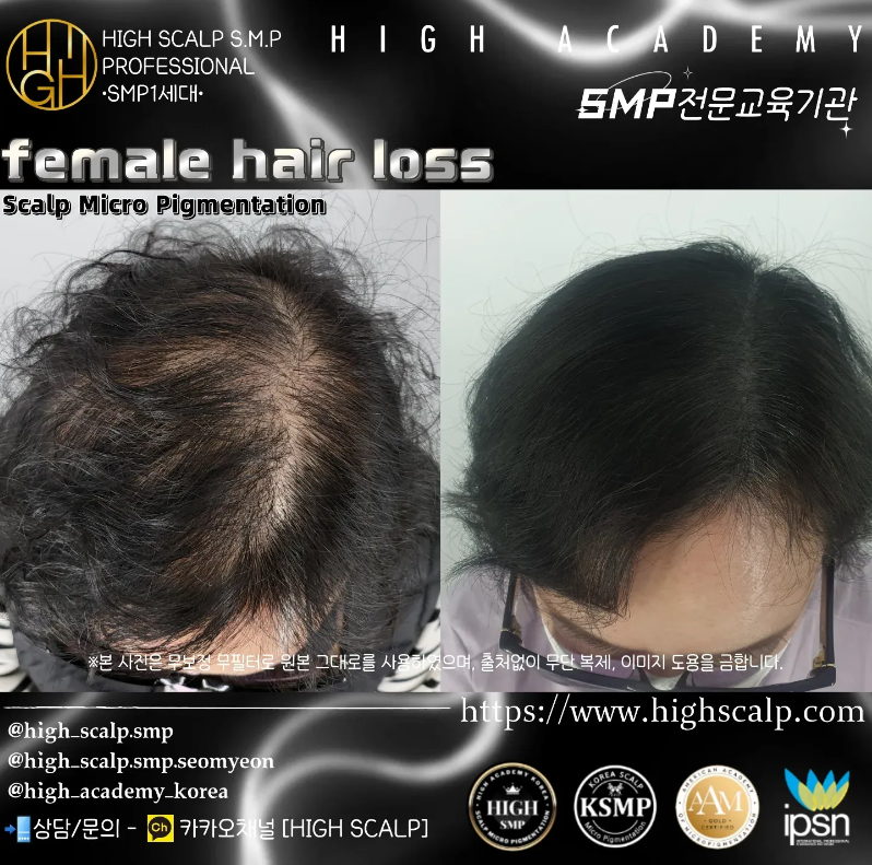 하이스칼프 이미지