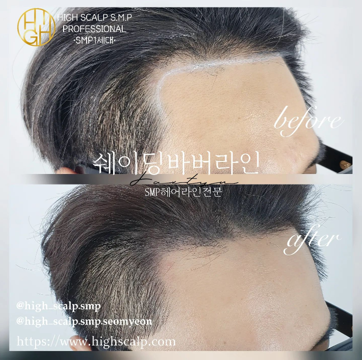 하이스칼프 이미지