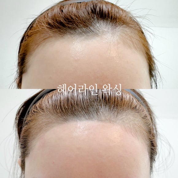 미미헤어라인 이미지