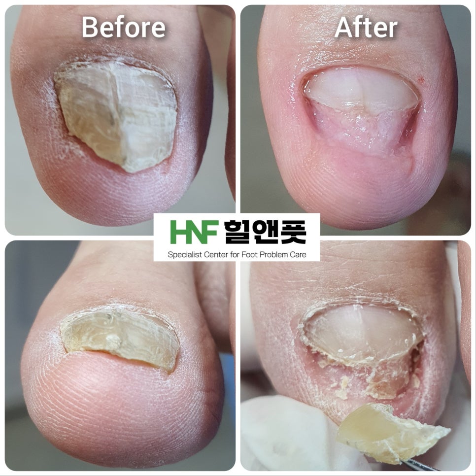 힐앤풋 이미지